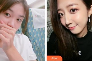 襄陽德爾美客西子醫(yī)療整形美容門診部黃亮誼整形價(jià)格表附硅膠隆鼻案例展示