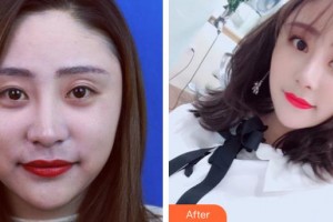 襄陽維多利亞醫(yī)療美容醫(yī)院曹仁昌整形價格表附鼻部綜合案例展示