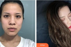 襄陽維多利亞醫(yī)療美容醫(yī)院端丹整形價格表附鼻部綜合案例展示