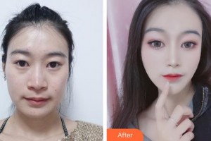 襄陽伊萊美醫(yī)療美容醫(yī)院鄭東學(xué)整形價(jià)格表附鼻部綜合案例展示