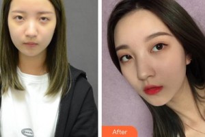 襄陽漢辰醫(yī)療美容門診部劉俊慧整形價(jià)格表附自體脂肪全臉填充案例展示