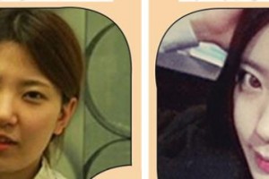 襄陽韓美醫(yī)療美容醫(yī)院段娟整形價(jià)格表附自體脂肪填充蘋果肌案例展示