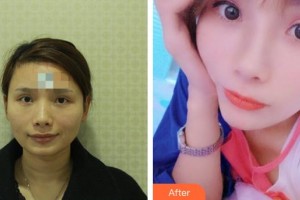 襄陽悅美醫(yī)療美容門診部吳學(xué)陽整形價(jià)格表附自體脂肪填充蘋果肌案例展示