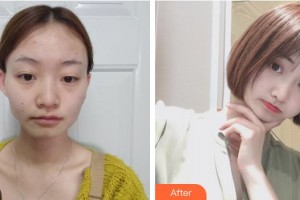 襄陽伯蒂醫(yī)療美容門診部葉武鋒整形價(jià)格表附自體脂肪全臉填充案例展示