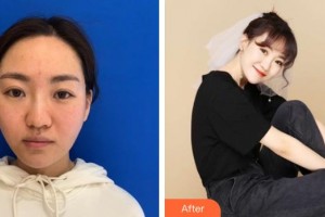 襄陽韓蔻醫(yī)療美容門診部王健強(qiáng)整形價(jià)格表附熱瑪吉案例展示