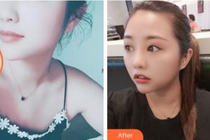 襄陽伊爾美整形美容醫(yī)院王光雪整形價(jià)格表附熱拉提案例展示