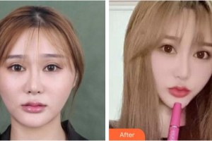 襄陽美嘉伊整形美容醫(yī)院鄭明哲整形價(jià)格表附埋線提升案例展示