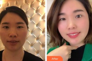 襄陽韓蔻醫(yī)療美容門診部劉永盛整形價(jià)格表附熱瑪吉案例展示