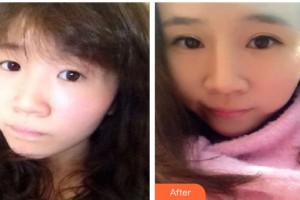 襄陽愛爾眼科醫(yī)院邱志方整形價(jià)格表附切開雙眼皮案例展示