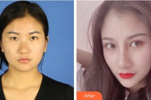 襄陽愛爾眼科醫(yī)院李紅莉整形價(jià)格表附眼部綜合案例展示