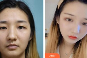 襄陽愛爾眼科醫(yī)院李卓君整形價(jià)格表附眼部綜合案例展示