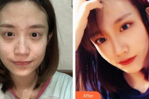 襄陽愛爾眼科醫(yī)院肖明整形價(jià)格表附眼部綜合案例展示