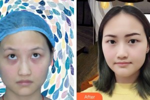 襄陽愛爾眼科醫(yī)院計(jì)虹整形價(jià)格表附激光去眼袋案例展示