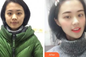 襄陽伊爾美整形美容醫(yī)院張?jiān)抡蝺r(jià)格表附眼部綜合案例展示