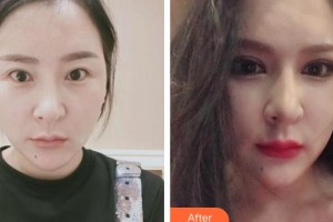 襄陽愛爾眼科醫(yī)院晉紅敏整形價(jià)格表附切開雙眼皮案例展示