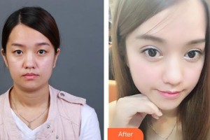 襄陽愛爾眼科醫(yī)院龔麟整形價(jià)格表附切開雙眼皮案例展示