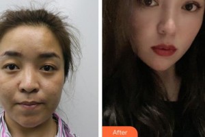 襄陽愛爾眼科醫(yī)院胡琴整形價(jià)格表附切開雙眼皮案例展示