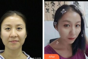 襄陽愛爾眼科醫(yī)院朱琴整形價格表附眼部修復案例展示