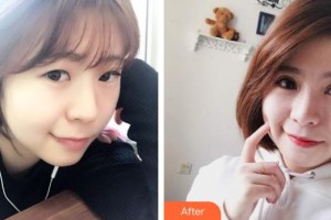 襄陽愛爾眼科醫(yī)院楊賀斌整形價格表附切開雙眼皮案例展示