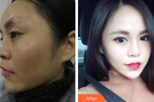 襄陽愛爾眼科醫(yī)院黃蓋整形價格表附眼部綜合案例展示