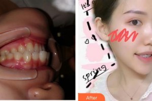 襄陽牙牙口腔門診部陳建鋼整形價格表附金屬托槽矯正案例展示