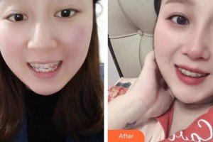 襄陽牙牙口腔門診部田丹丹整形價格表附牙齒隱形矯正案例展示