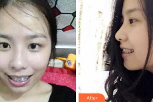 襄陽市口腔醫(yī)院閆寒松整形價格表附金屬托槽矯正案例展示