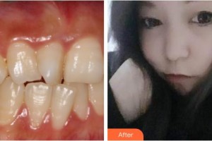 襄陽牙牙口腔門診部王林虎整形價(jià)格表附牙齒隱形矯正案例展示