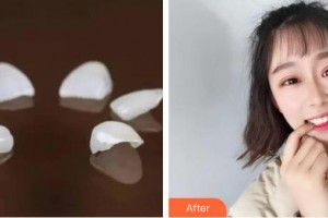 襄陽時(shí)代口腔醫(yī)院任旭東整形價(jià)格表附美白貼片案例展示