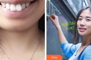 襄陽時(shí)代口腔醫(yī)院趙恒整形價(jià)格表附金屬托槽矯正案例展示