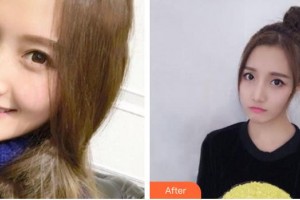 襄陽市第一人民醫(yī)院李德勝整形價(jià)格表附埋線提升案例展示