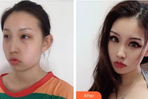 襄陽市第一人民醫(yī)院劉羽整形價(jià)格表附熱瑪吉案例展示