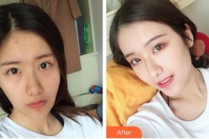 襄陽市第一人民醫(yī)院吳小軍整形價(jià)格表附拉皮手術(shù)提升案例展示