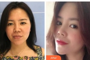 襄陽市第一人民醫(yī)院王慧整形價(jià)格表附埋線提升案例展示