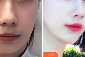 襄陽市第一人民醫(yī)院潘穎喆整形價(jià)格表附埋線提升案例展示