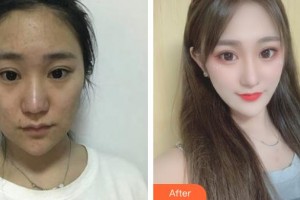 襄陽市第一人民醫(yī)院李運(yùn)安整形價(jià)格表附激光美膚激光案例展示