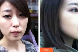 襄陽市第一人民醫(yī)院劉剛整形價(jià)格表附埋線提升案例展示