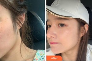 襄陽市第一人民醫(yī)院陳勇整形價(jià)格表附激光美膚激光案例展示