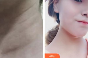 襄陽市第一人民醫(yī)院周新春整形價(jià)格表附嗨體去頸紋案例展示