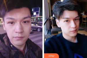 襄陽市第一人民醫(yī)院殷暉整形價(jià)格表附埋線提升案例展示