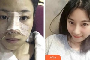 恩施華美整形美容門診部王玉榮整形價(jià)格表附鼻部綜合案例展示