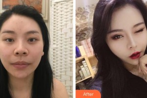 恩施華美整形美容門診部埃倫整形價(jià)格表附肋軟骨隆鼻案例展示