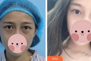 恩施慧益眼科醫(yī)院肖紫云整形價格表附內(nèi)切祛眼袋案例展示