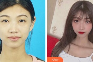 恩施慧益眼科醫(yī)院周瑜整形價格表附內(nèi)切祛眼袋案例展示