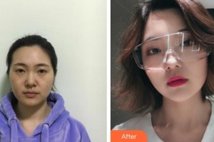 仙桃憶美醫(yī)療美容門診部高峽整形價格表附埋線提升案例展示