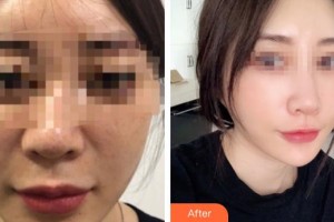 仙桃友好醫(yī)學(xué)美容醫(yī)院胡霜紅整形價格表附埋線提升案例展示