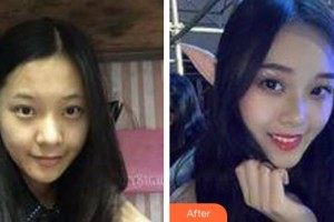 仙桃友好醫(yī)學(xué)美容醫(yī)院吳小蔚整形價格表附膠原蛋白除皺案例展示