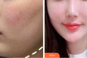 仙桃憶美醫(yī)療美容門診部熊一頻整形價格表附埋線提升案例展示