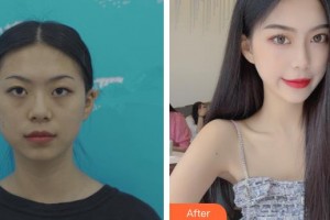 仙桃愛爾眼科醫(yī)院何碧華整形價格表附眼部綜合案例展示