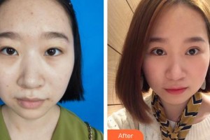 潛江藍(lán)鳥醫(yī)療美容診所黃星整形價格表附切開雙眼皮案例展示